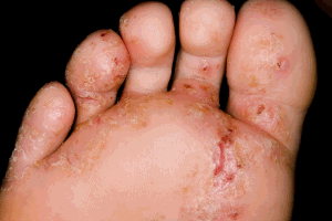 Red Skin Blotches on the Hand | LIVESTRONG.COM